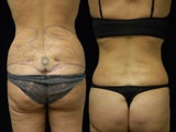 Smartlipo Triplex liposuction of the waist and flanks. Cellullaze of the buttocks and thighs
