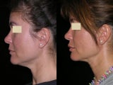 Smart Liposuction of the neck