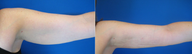 Smart Lipo