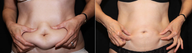 Smart Lipo