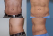Smartlipo