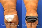 SmartLipo of Back Bra Rolls and Waist Line