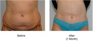 Smart Lipo