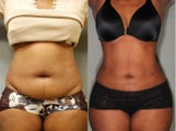 44 Year old Female SmartLipo