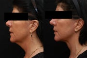 Smartlipo MPX - Neck/Jowls