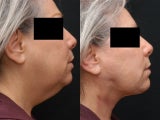 SmartLipo/MPX Neck and Jowls