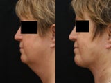 SmartLipo/MPX Neck and Jowls
