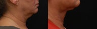 SmartLipo MPX neck & jowls