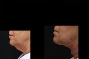 SmartLipo MPX neck and jowls