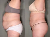 66 Year Old Female Lost 15"
