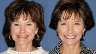 Smile Makeover
