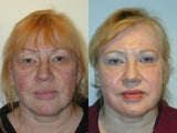 Trichloroacetic Acid Peel (TCA) and Upper Lid Blepharoplasty