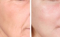 TCA Chemical Peel with 35% TCA