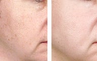 TCA Chemical Peel with 35% TCA