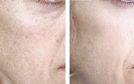 TCA Chemical Peel with 35% TCA