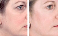 Facial chemical peel with 35% TCA