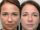 Obagi Blue Peel, Upper and Lower Blepharoplasty