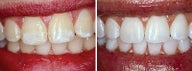 Teeth Whitening with Opalescence