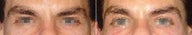 Eye "lift" with Thermage