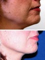 Thermage to jaw line and chin