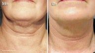 Thermage to Neck, chin and jaw line