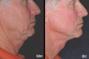 Thermage to neck and jaw line