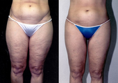 Thigh Lift