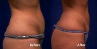 Tummy liposuction