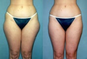 Lipoosuction of the saddlebags and thighs