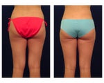 Liposuction