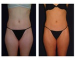 Liposuction
