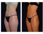 Liposuction