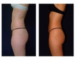 Liposuction
