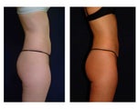 Liposuction