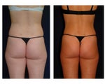 Liposuction