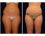 Liposuction