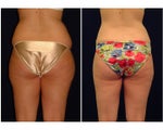 Liposuction