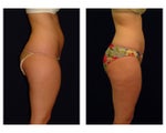 Liposuction