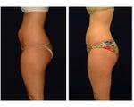 Liposuction