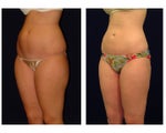 Liposuction