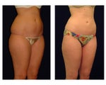 Liposuction
