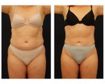 Liposuction