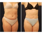 Liposuction