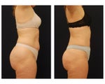 Liposuction