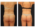 Liposuction