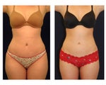 Liposuction