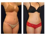 Liposuction