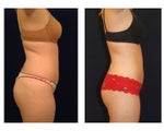 Liposuction