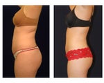 Liposuction
