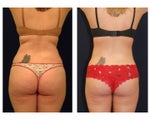 Liposuction